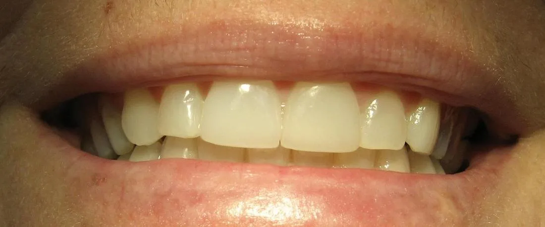 25875 porcelain veneers types