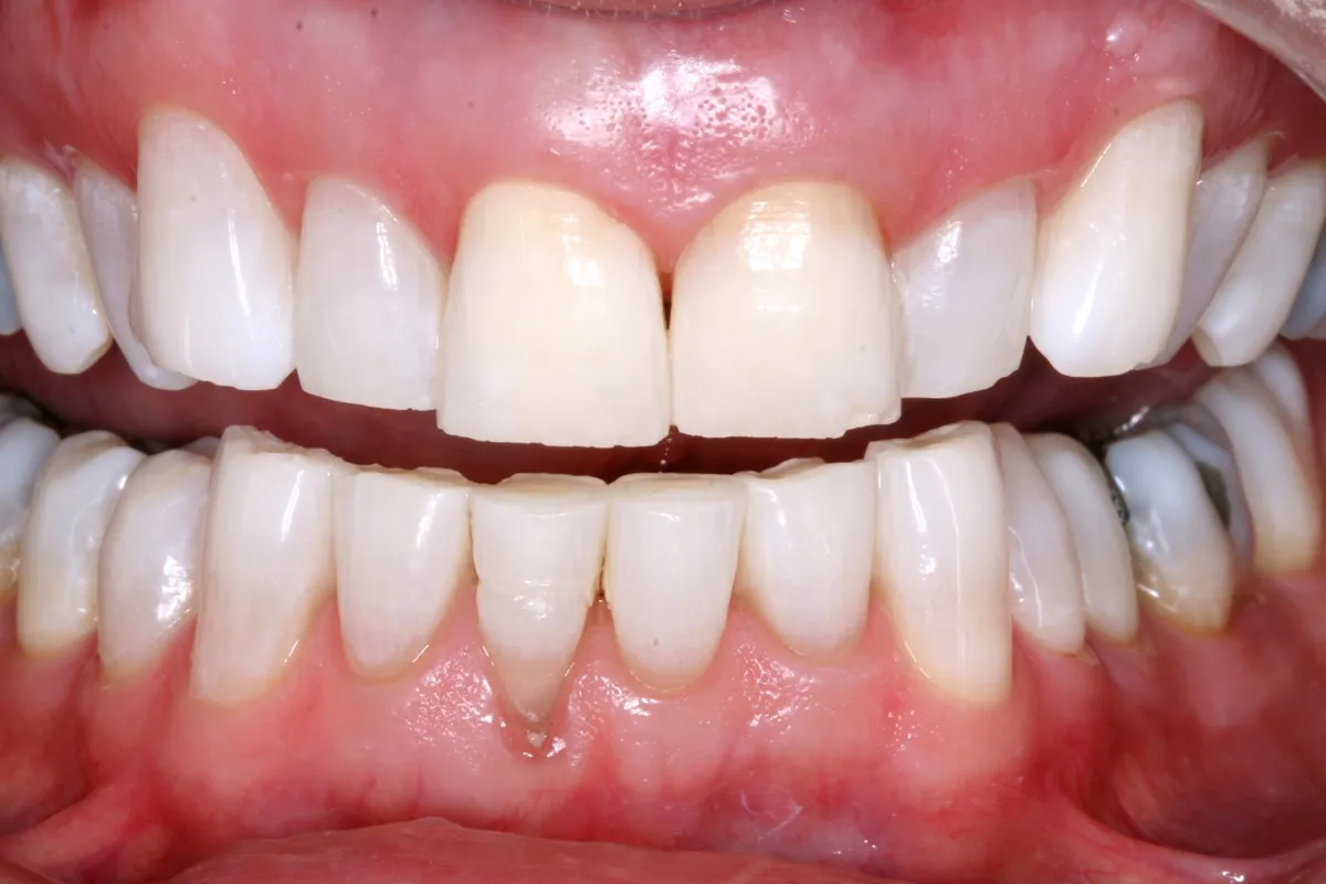 25876 preventing teeth discoloration