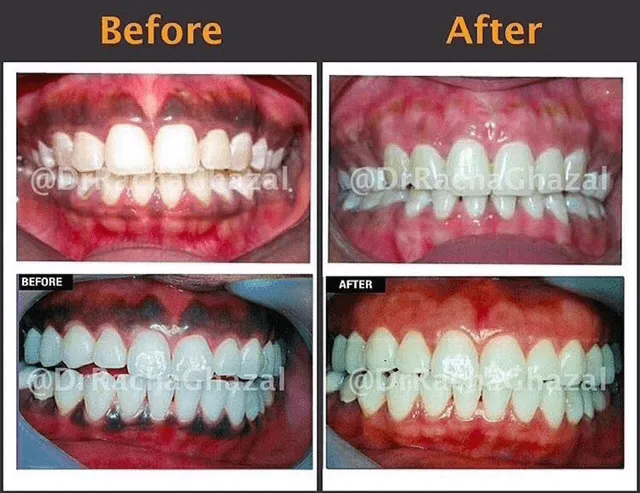 25878 dark gums causes