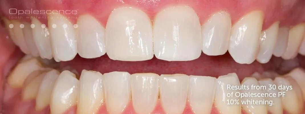 25880 sensitive teeth whitening